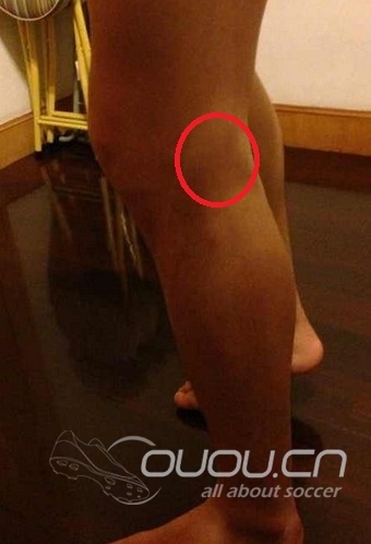 膝关节侧面有个痛点,不知道叫啥, 求解