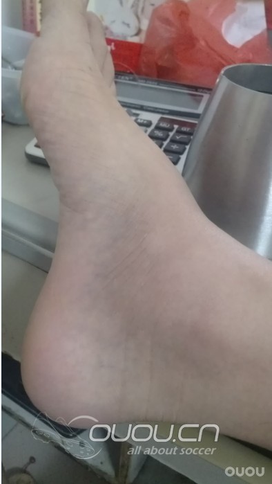 脚踝受伤一个多月了一直没消肿,咋回事?