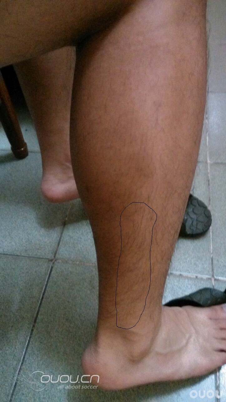 求解脚上两处伤