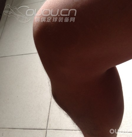 求助,小腿撞伤,肿得跟膝盖这么大?怎么处理?