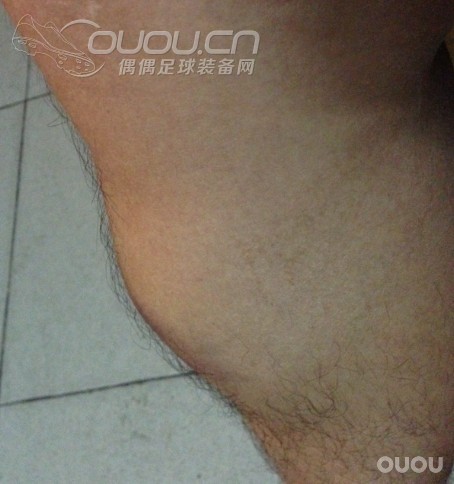 求助,小腿撞伤,肿得跟膝盖这么大?怎么处理?