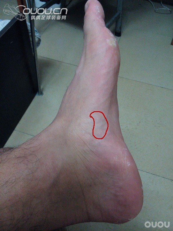 求助各位老鸟,脚踝老伤的处理?