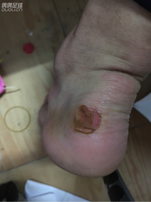 耐克鬼牌AG会磨脚,有没有哪个兄弟知道怎么处理