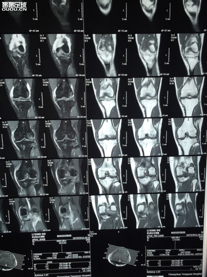 去年右膝十字韧带让人撞断了 刚恢复没踢几场左膝又自己扭断了