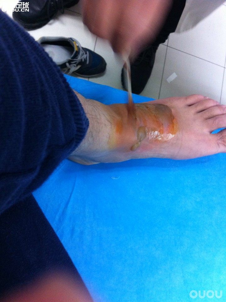 X16.1皮版穿了大半年感觉棒棒哒可惜了这右脚被烫伤 明年再战???