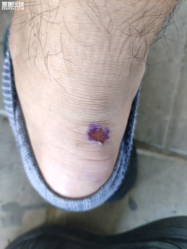 买了双NB的球鞋,穿了大约一个小时。左脚跟腱处磨泡,右脚跟腱处磨破皮,怎么处理能不再磨泡?