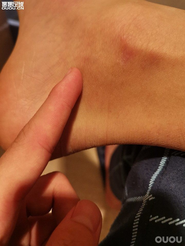 各位大佬们,一周前踢球跟腱受损,处理后好转,但贴药之后这里有点过敏,也没敢再贴