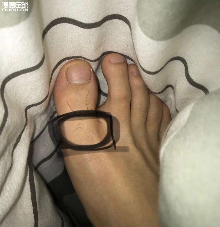 我习惯脚是右脚,一年前踢球一个动作搞得右脚趾头往下一点的关节痛(如图所示)