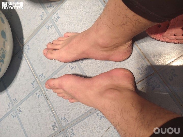 兄弟们,我的脚内侧鼓起来了,按不下去,这是怎么了,严重嘛?