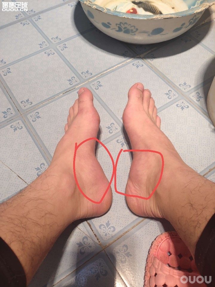 兄弟们,我的脚内侧鼓起来了,按不下去,这是怎么了,严重嘛?