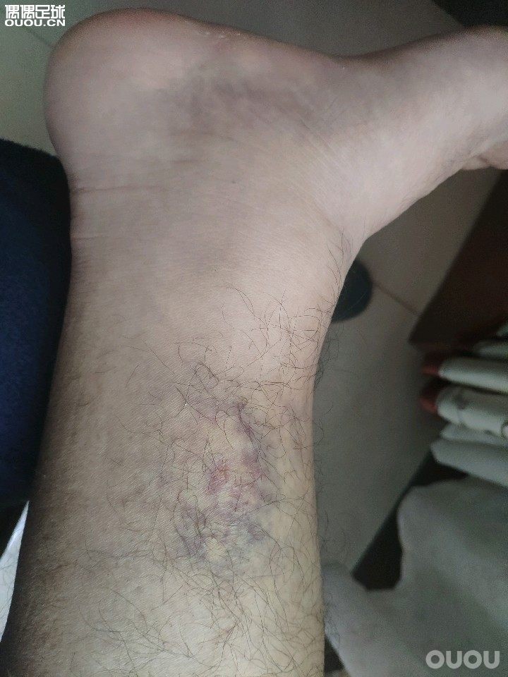 前几天踢球小腿被提到,现在小腿有点水肿的感觉,按下去会出现一个坑。这样是正常的吗?要怎么样快速消肿?