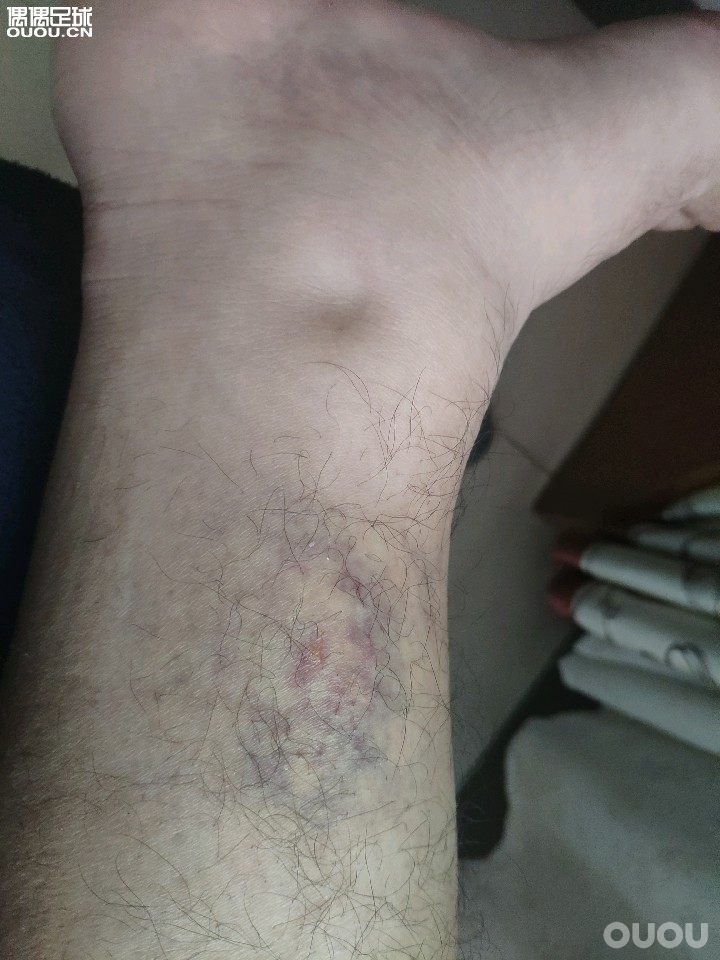 前几天踢球小腿被提到,现在小腿有点水肿的感觉,按下去会出现一个坑。这样是正常的吗?要怎么样快速消肿?